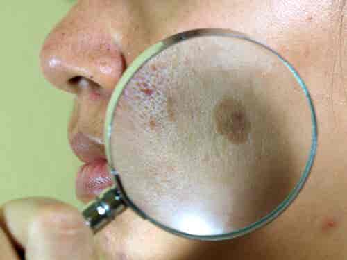 7 tratamientos naturales para el paño en la cara