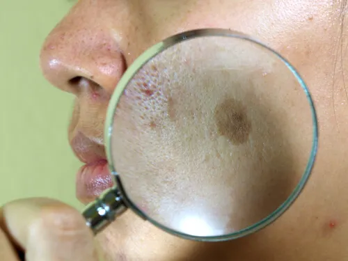 paño o melasma