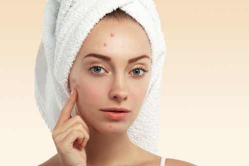Usos de la vainilla para mejorar la piel y el cabello: evitar aparición de acné