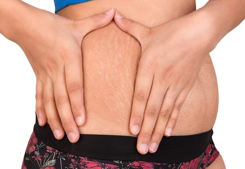 2 alternativas naturales para tratar las estrías
