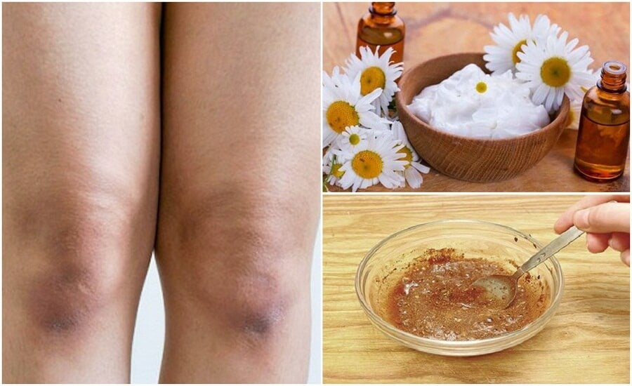 Aclara la piel de tus rodillas con estos 5 exfoliantes naturales - Mejor  con Salud