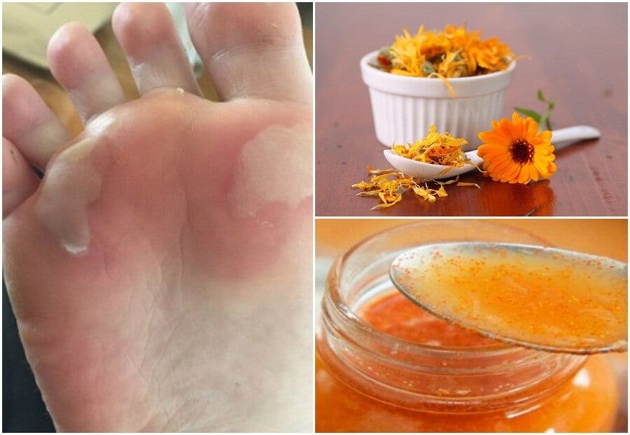 ¿Cómo curar las ampollas o rozaduras en la planta del pie?