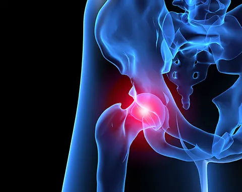 Choque femoroacetabular