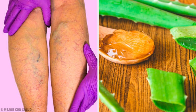 Remedio de aloe vera para las varices