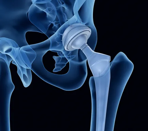 Osteogénesis imperfecta