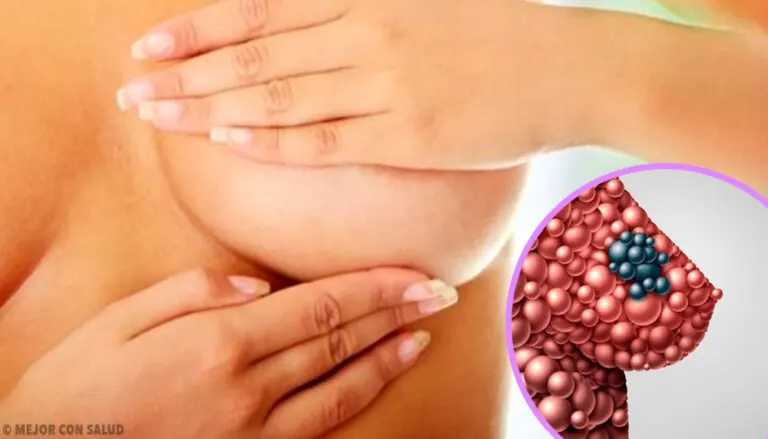 Quistes mamarios: qué son y cómo se forman