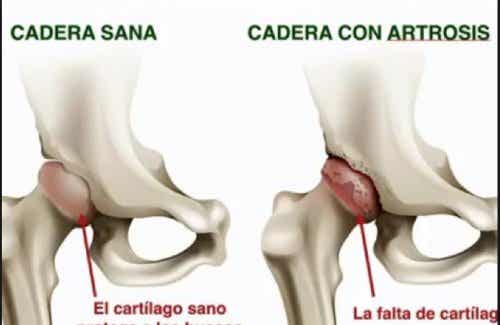 artrosis de cadera