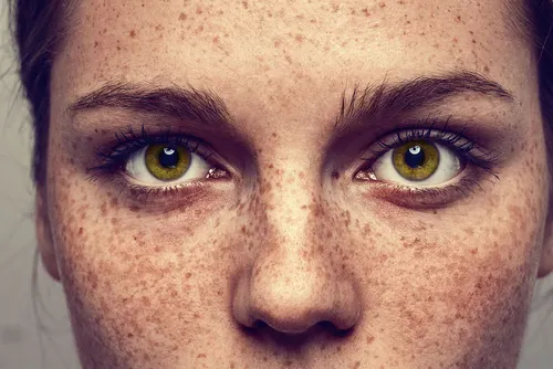 Es posible elimina las pecas de manera totalmente natural