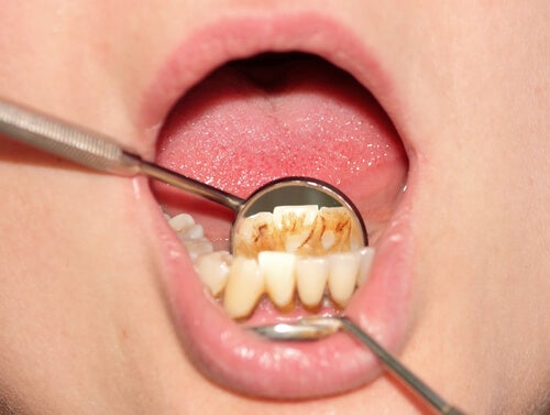 Cómo quitar el sarro de los dientes | Domus Dental A Coruña