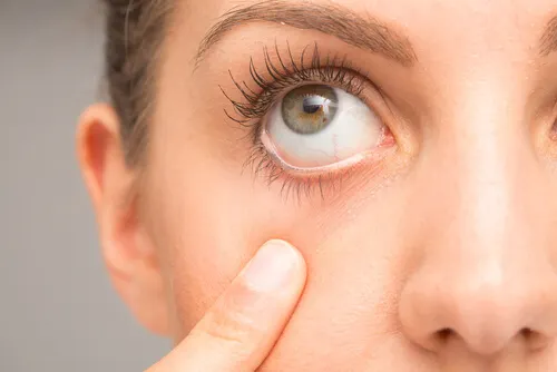 Ojos irritados