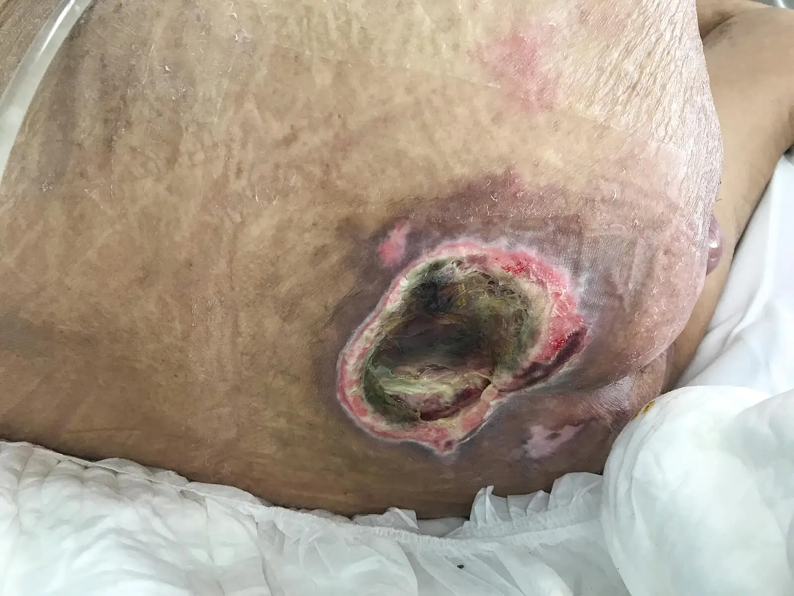 úlcera o escara por postramiento en cama.