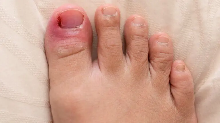 Elimina los uñeros con estos 8 tratamientos naturales