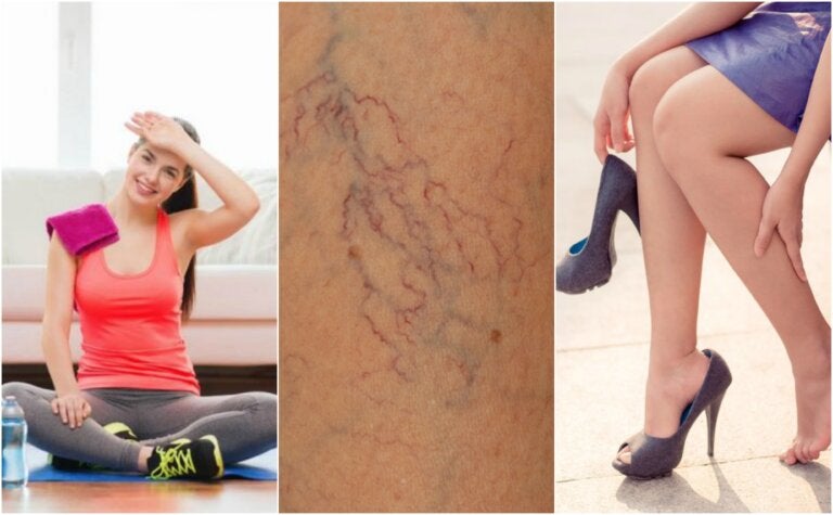 8 cosas que puedes hacer para prevenir las arañitas vasculares