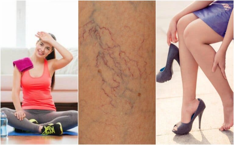 8 cosas que puedes hacer para prevenir las arañitas vasculares