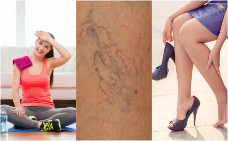 8 cosas que puedes hacer para prevenir las arañitas vasculares