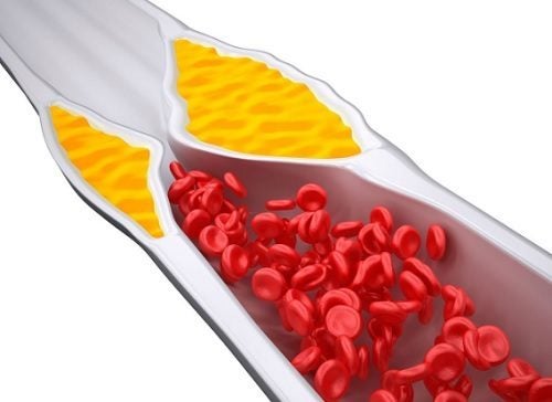 Ateroesclerosis