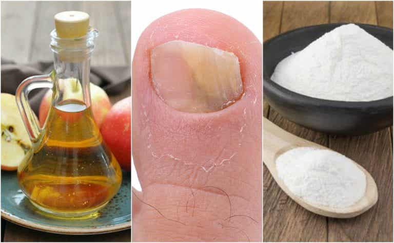 Combate los hongos en las uñas con vinagre de manzana y bicarbonato de sodio