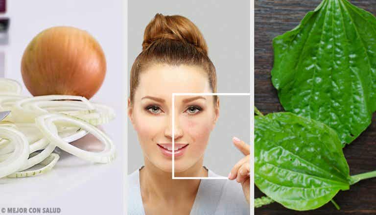 Cómo eliminar manchas en la cara con ingredientes naturales
