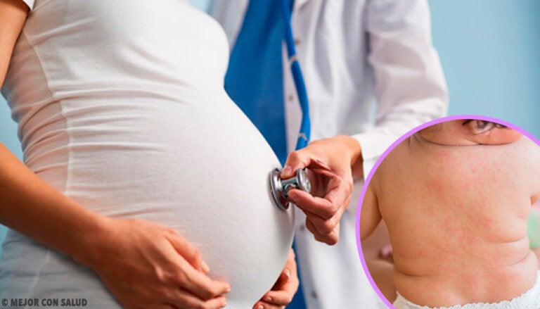 La roséola durante el embarazo