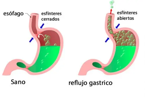 Los esfínteres del esófago