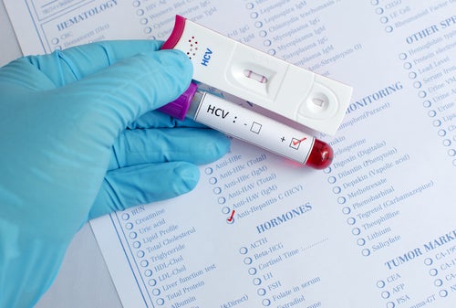 Analítica del HCV