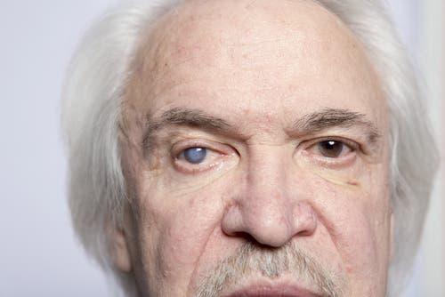 Paciente anciano con glaucoma