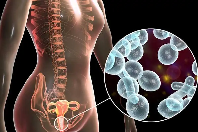 Infección por levaduras