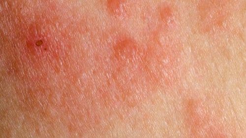 redness and swelling