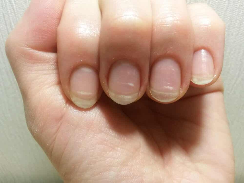 Manchas blancas en las uñas.