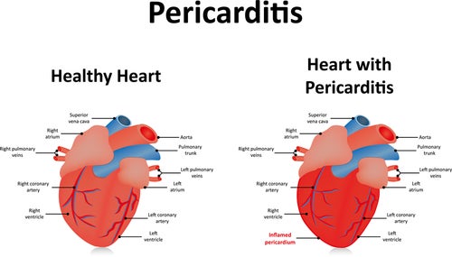 Corazón con pericarditis