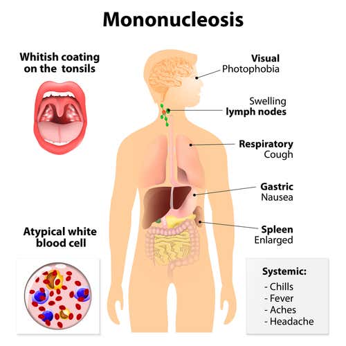 Síntomas mononucleosis