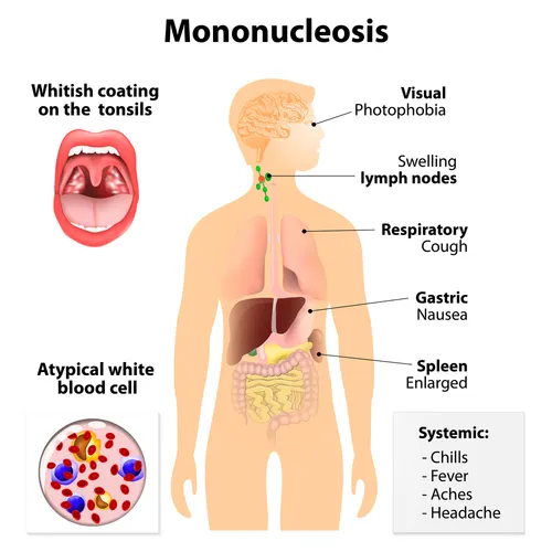 Síntomas mononucleosis