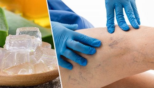 5 alternativas para tratar las varices