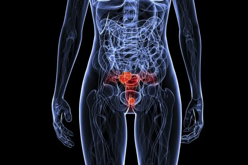 Cuadros clínicos del virus del papiloma humano