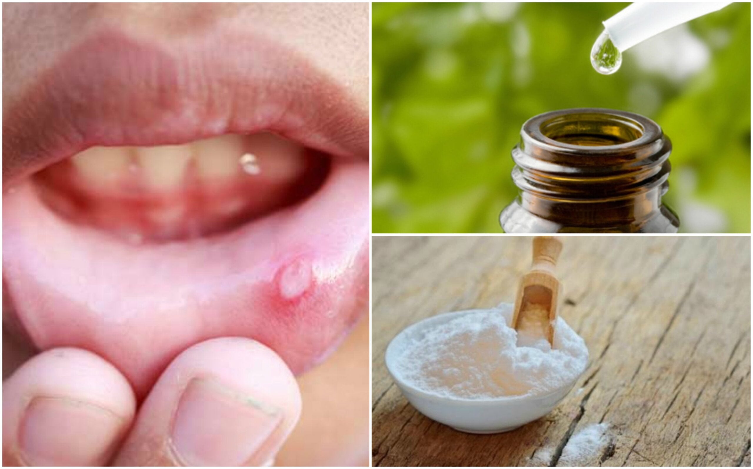 Alivia las aftas bucales usando estos 6 remedios de origen natural - Mejor con Salud