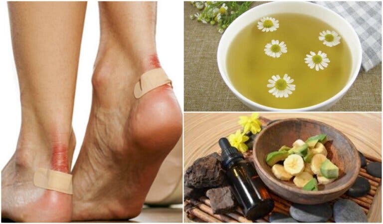 Alivia las rozaduras en los pies con estas 5 soluciones naturales