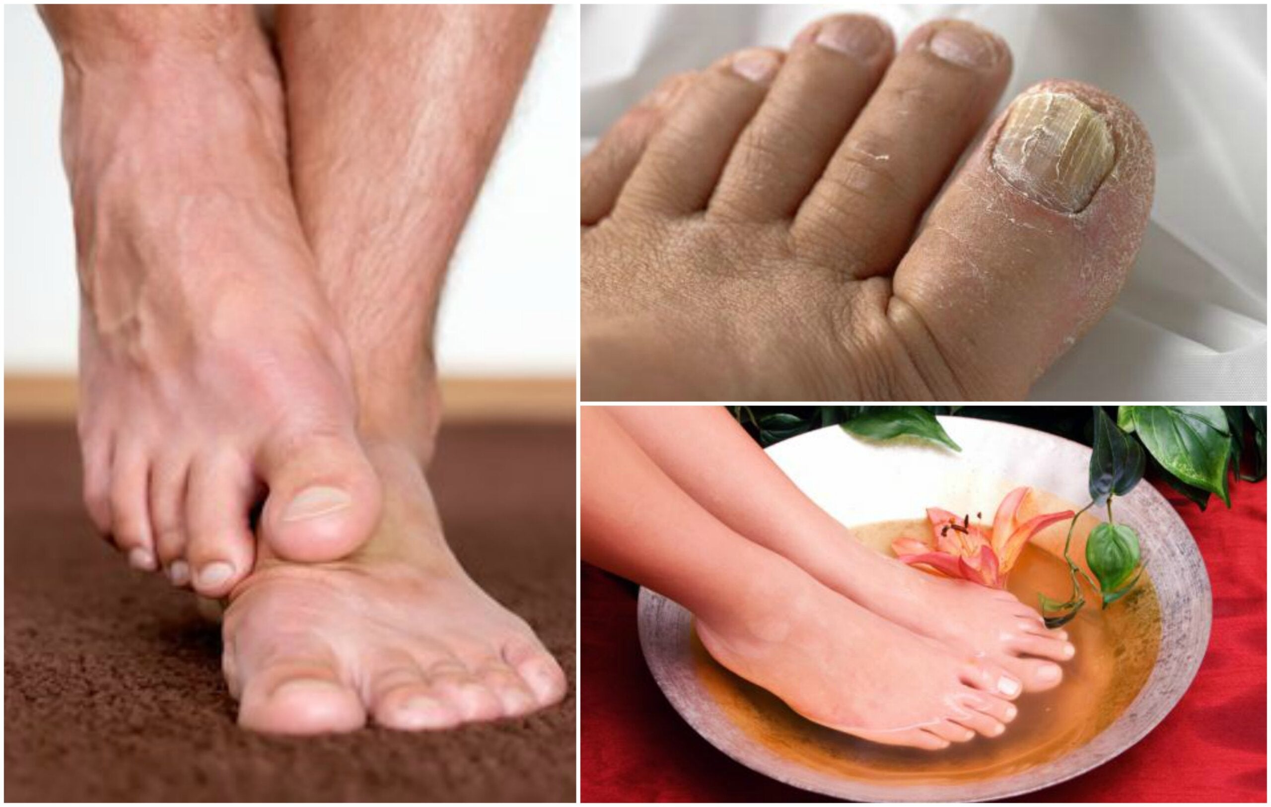 Cómo identificar si tienes hongos en los pies - Mejor con Salud