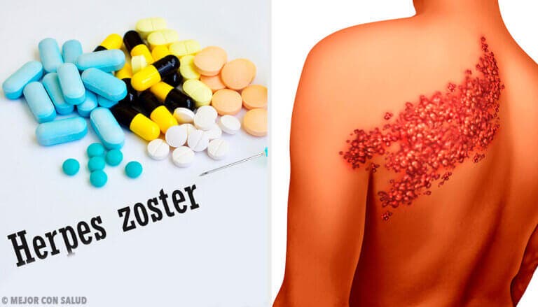Herpes zóster