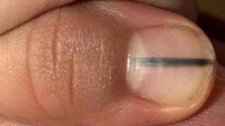 ¿Una línea negra en tus uñas podría ser una señal de cáncer?