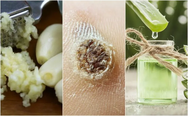 ¿Tienes verrugas en tu piel? Combátelas naturalmente con estos 5 remedios