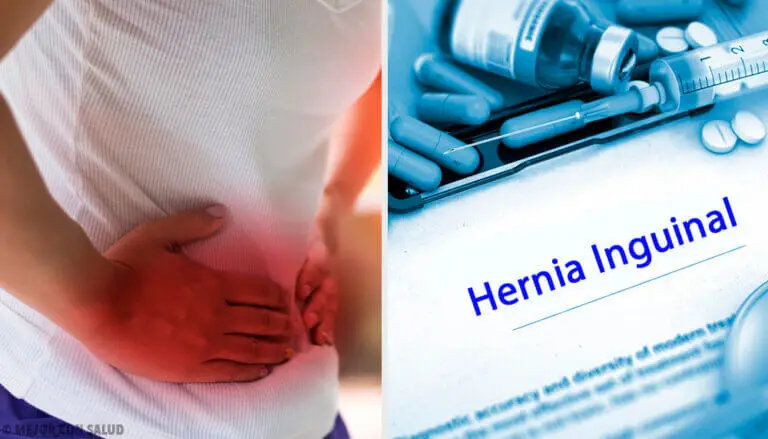 Tratamiento de la hernia inguinal