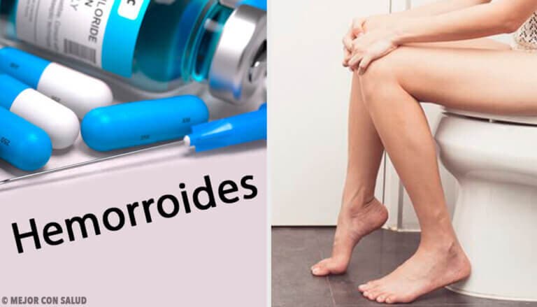 Tratamiento de las hemorroides