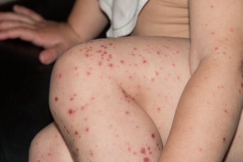 Virus Coxsackie: ¿Cómo afecta a adultos y niños, y cómo protegerse de él?