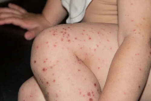 Virus Coxsackie: ¿Cómo afecta a adultos y niños, y cómo protegerse de él?