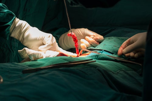Cirujanos practicando una apendicectomía.