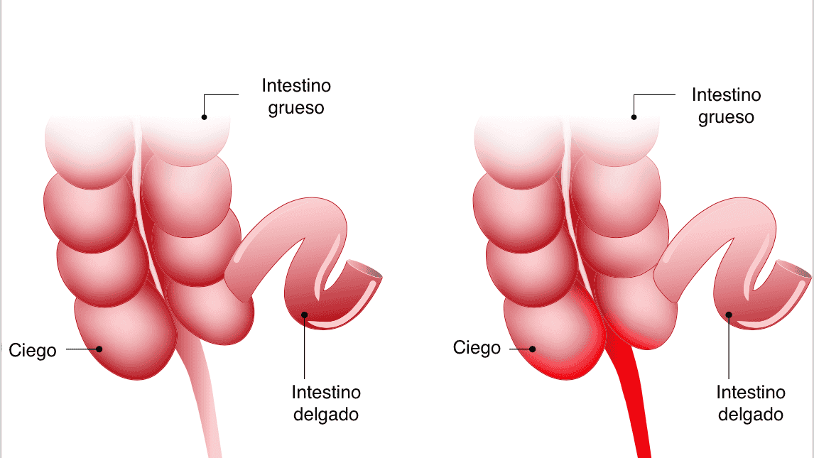 Síntomas de la apendicitis en niños - Mejor con Salud