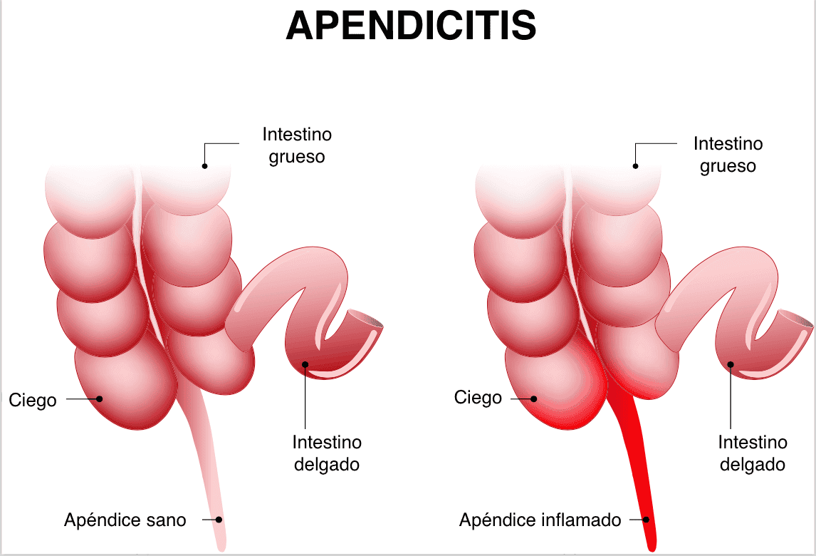 Apendicitis en niños.