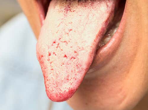 Síntomas de candidiasis en la lengua