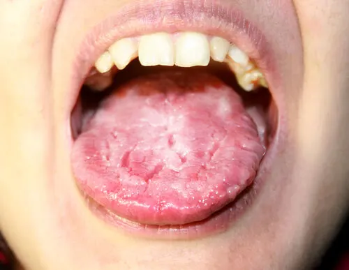 Candidiasis