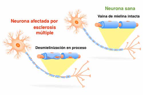 Neurona con esclerosis múltiple y neurona sana